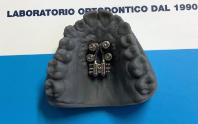 E.R.P. ad Ancoraggio Scheletrico su 4 Mini-impianti